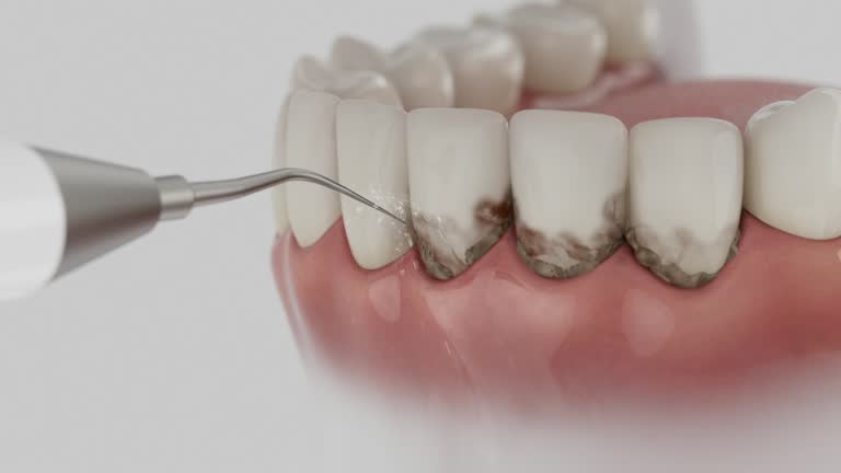Trusted Teeth Cleaning And Checkup service in West Lafayette, IN - Dentist Open Now